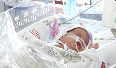 افزایش تولد نوزادان نارس در سال های اخیر