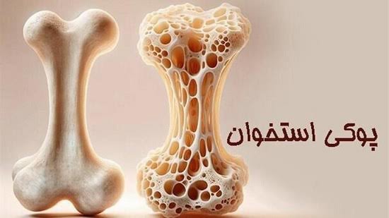 پوکی استخوان، بیماری خاموشی قابل پیشگیری با تشخیص زودهنگام