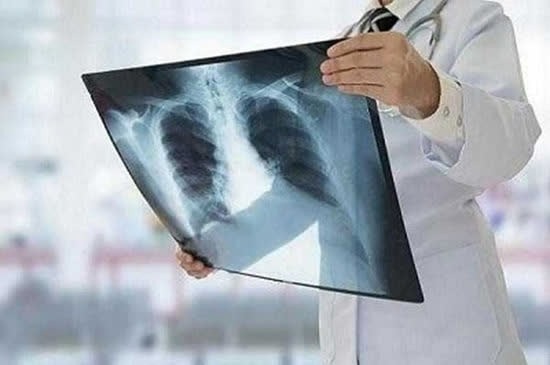 شناسایی ۱۱ بیمار جدید مبتلا به سل در کاشان